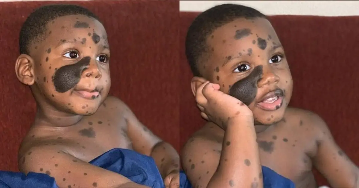 Amazing photos of young boy looking cute with his deep visible birthmarks go viral