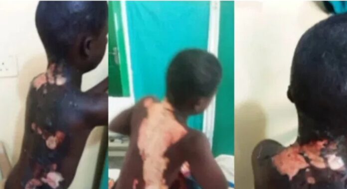 Kasoa: 10-year old boy set ablaze by angry weed-smoking teenager
