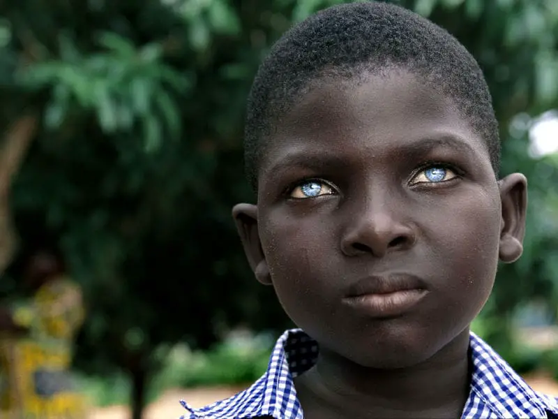 Why do some Black Africans have blue eyes? Separating fact from fiction