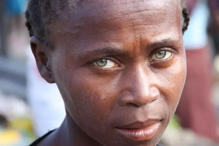 Why do some Black Africans have blue eyes? Separating fact from fiction